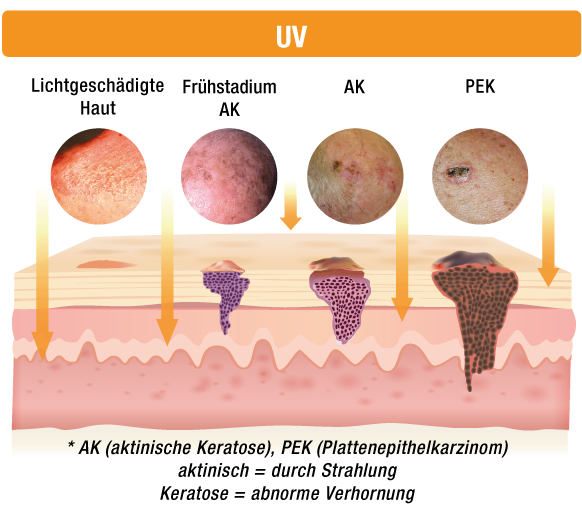 Was Ist Eine Aktinische Keratose Pierre Fabre Dermatologie